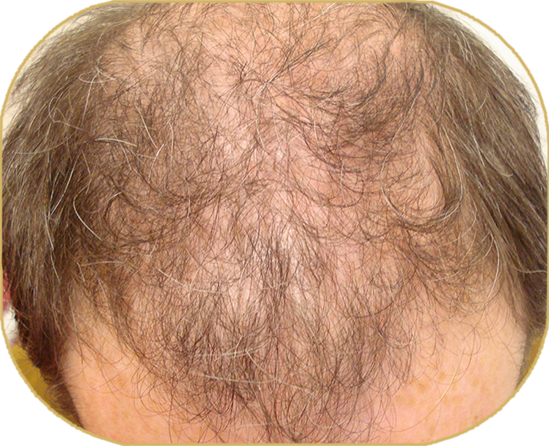 Hairmedic - Hair Loss Treatments for Women & Men | Trichologists